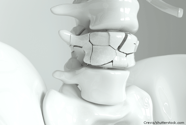 Osteoporose_640
